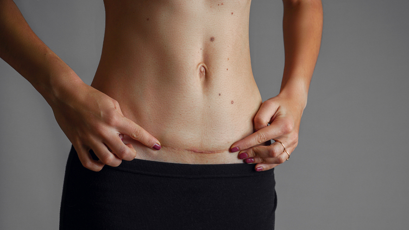 Indicações do body lift e perfil de pacientes com Dr. Haeckel Cabral.